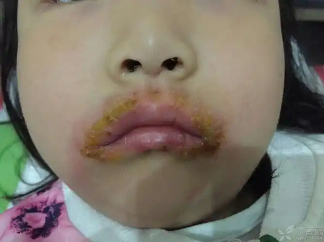 求助,家中3岁孩子口角溃疡!