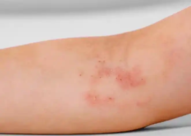 特应性皮炎是什么原因造成的?小孩和成年人的症状有什么不同?