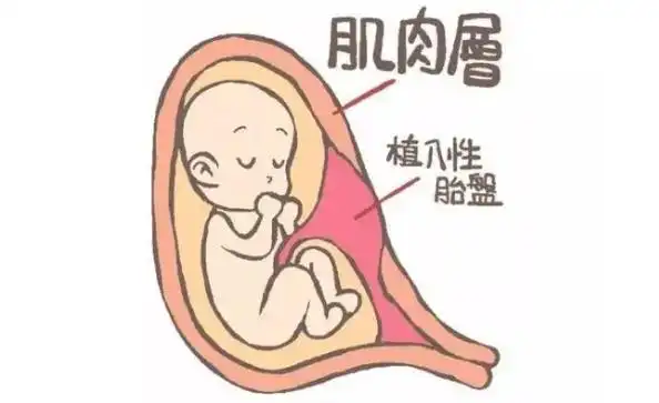 胎盘植入容易大出血如何避免出现胎盘植入