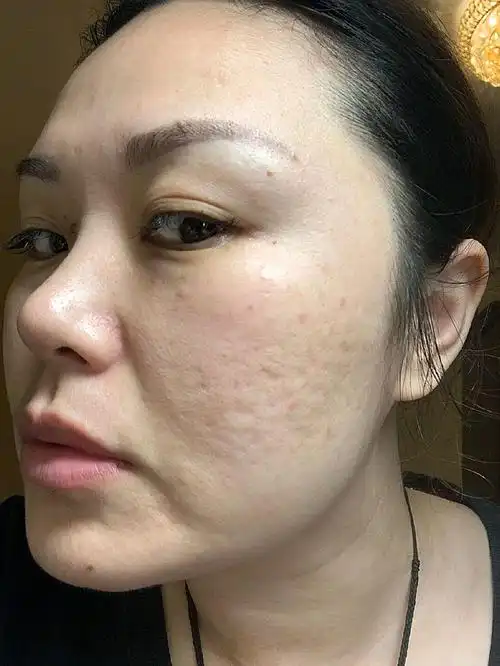 做完点阵激光去痘印十天左右的变化,因为我自己的痘印_圈子-新氧美容