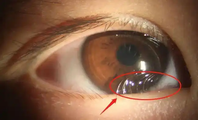 手术治疗:通常有眼睑缝线法,单纯眼睑切开法,下睑内翻矫正联合内眦赘