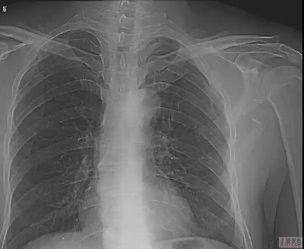 [请教]肩胛骨骨折