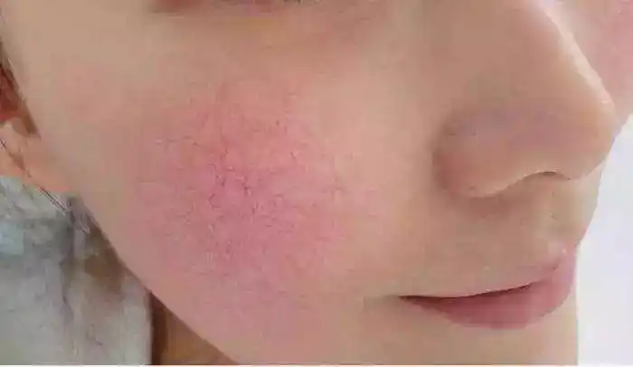 角质层下方就开始合成炎症信号il-1α,也就意味着要出现屏障受损了