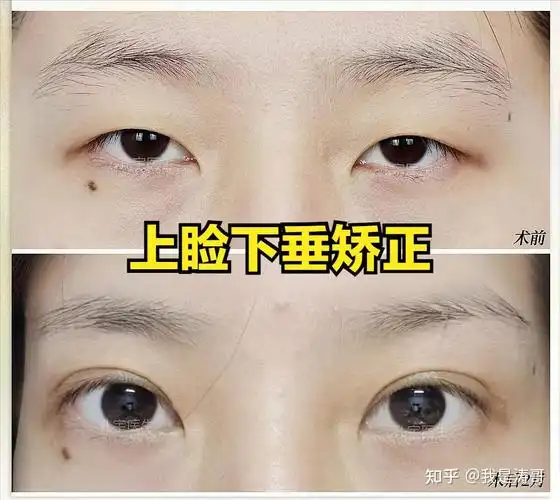 为什么眼睑肌无力的人做了双眼皮后像变了个人一样