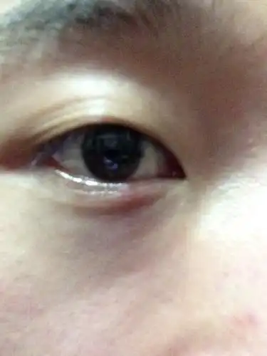 我的下眼皮突然肿了,怎么办?