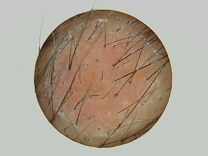 一支生发针解决国民新痛点让头皮毛囊获得新生