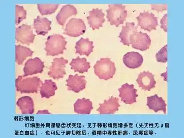 主管检验技师辅导红细胞形态异常