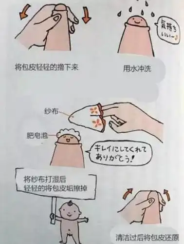 儿童包茎治疗经历及感想