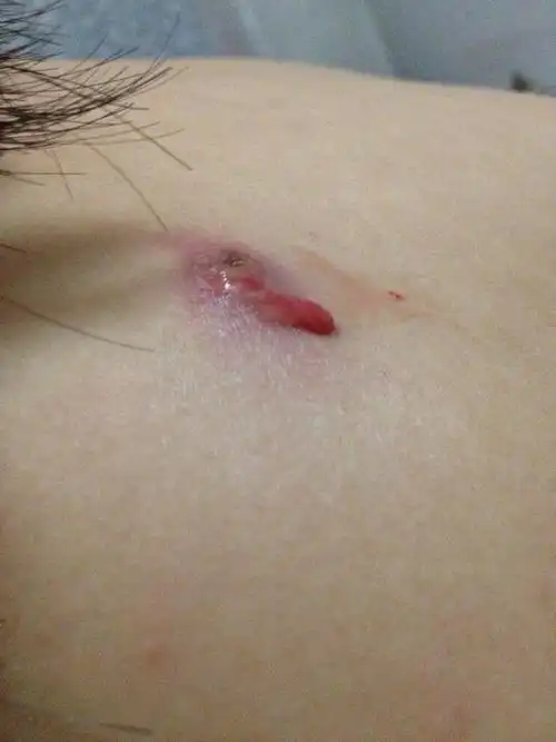 疙瘩在背后长了好几天了 红肿 碰着就疼 老公给我