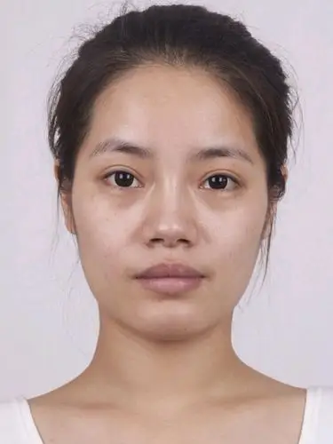 术前我的鼻头比较大,鼻翼也比较宽,侧面看着很扁平,_圈子-新氧美容