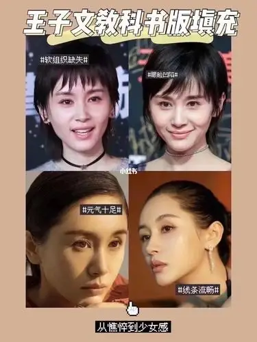 王子文的面部填充有没有惊艳到你