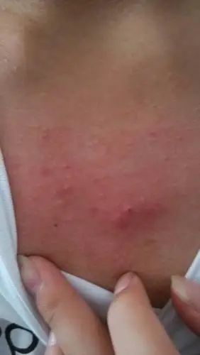 胸口上起好多红痘痘,怎么办 用什么药 可以用复方醋酸地塞米松软膏吗?