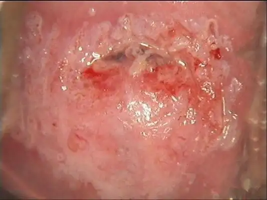 宫颈癌图片 (32)