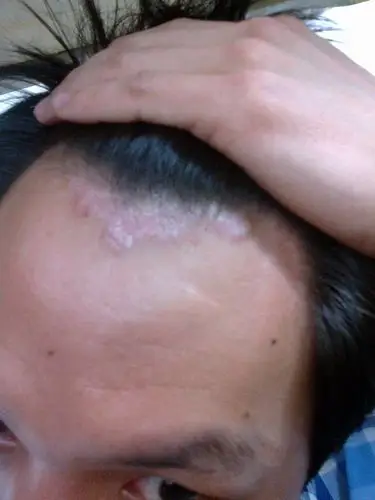 女生的头癣初期图片_有来医生