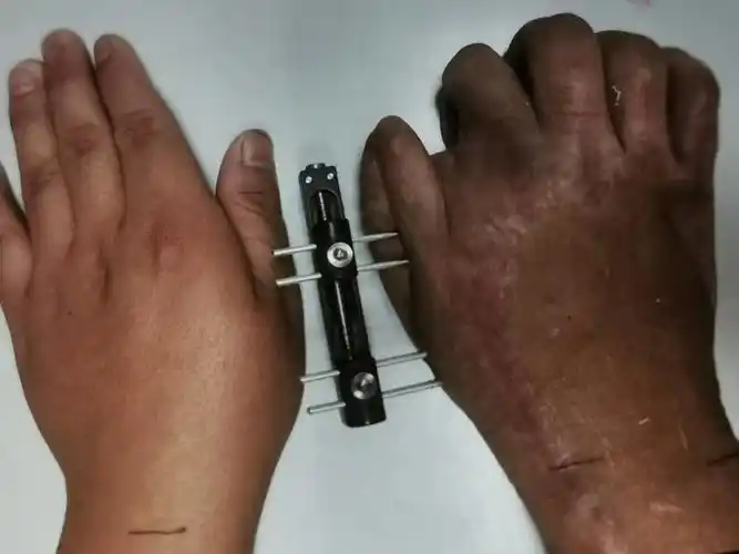 手指延长再造术 - 好大夫在线