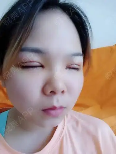 全切双眼皮术后5天_双眼皮术后5天_眼部整形术后5天_寒冬里的小确幸