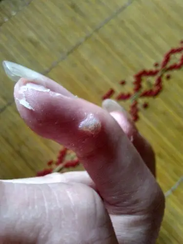 这种肉瘤在我手指上有一两年了最初的时候只有一个现在又长出了两