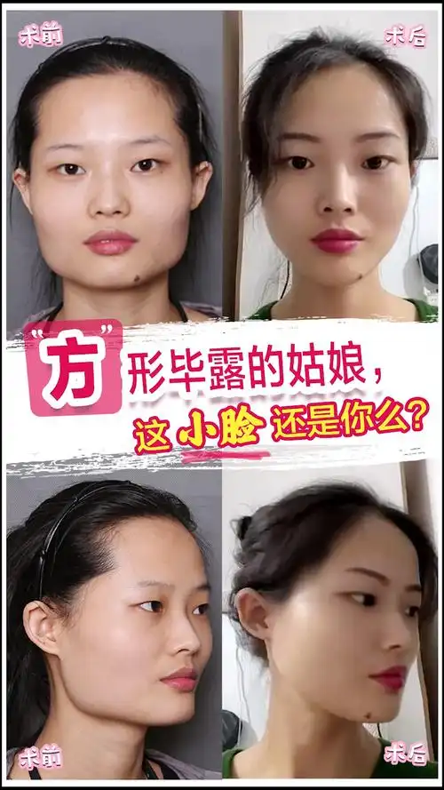 25岁方脸改脸型时皇叔是怎么设计的呢