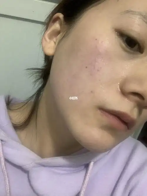 敏感肌修复 任重而道远_过敏_洗面奶_修复敏感肌_敏感肌_防晒_至本