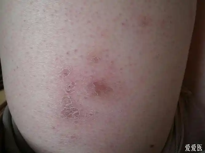 有奖猜答2公布答案寒冷性脂膜炎第一答对的加分其余送花鼓励