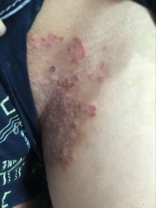 大腿外侧股癣 图片_有来医生