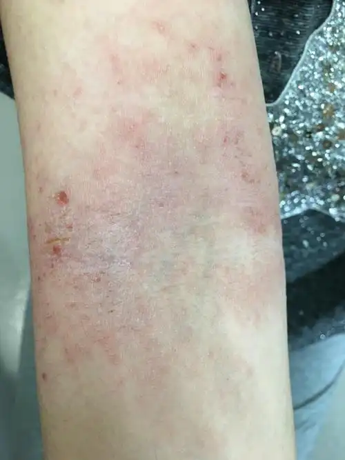 特应性皮炎的疑问和解答_特应性皮炎_疾病介绍_介绍 - 好大夫在线