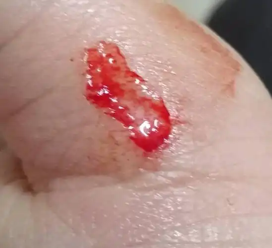 请问这个伤口需要打破伤风吗?已经去诊所拿碘酒消毒和加消炎药包扎了.