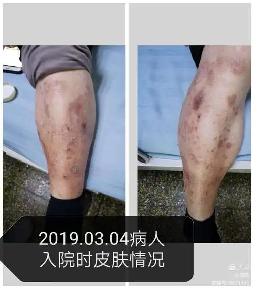 其它 一例糖尿病皮肤病变病例观察 写美篇           胫前色素斑是
