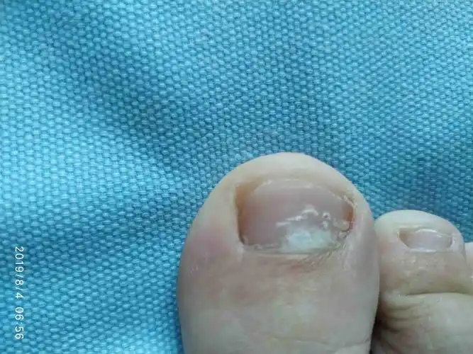 昨天发现的,脚趾甲根部表白了,其他的脚趾甲没有,是不是灰指甲啊