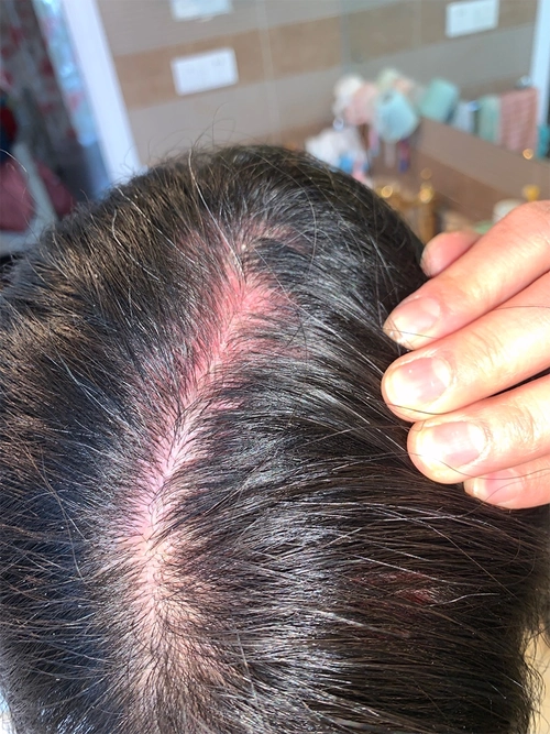 邓雅文医师 | 治疗头皮红斑狼疮,快,狠,准!