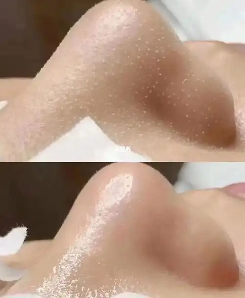 小气泡深层清洁