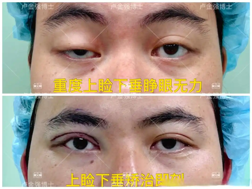 术前左眼提肌无力,遮挡瞳孔,比较影响日常生活,术后即刻眼睛变大了,能