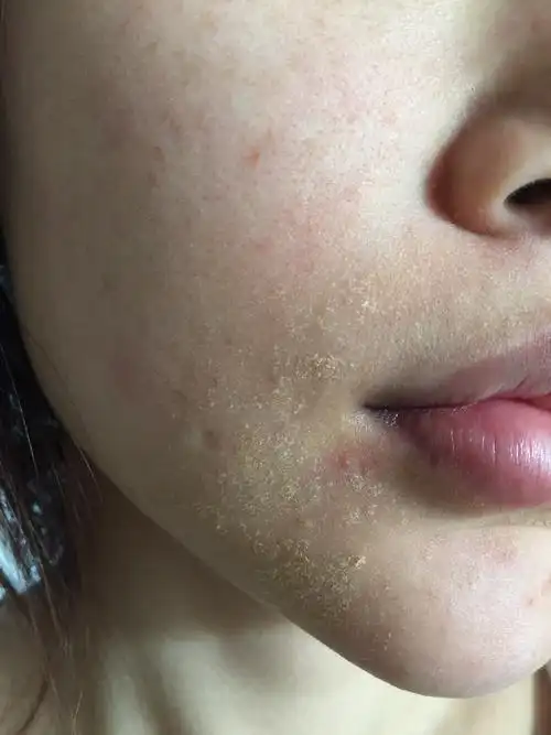 曾经用过激素类药物.去就诊过说是脂溢性皮炎.