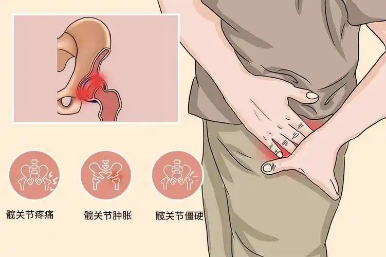 有这个症状,就要小心了!活用这两个药方,巧治股骨头坏死!