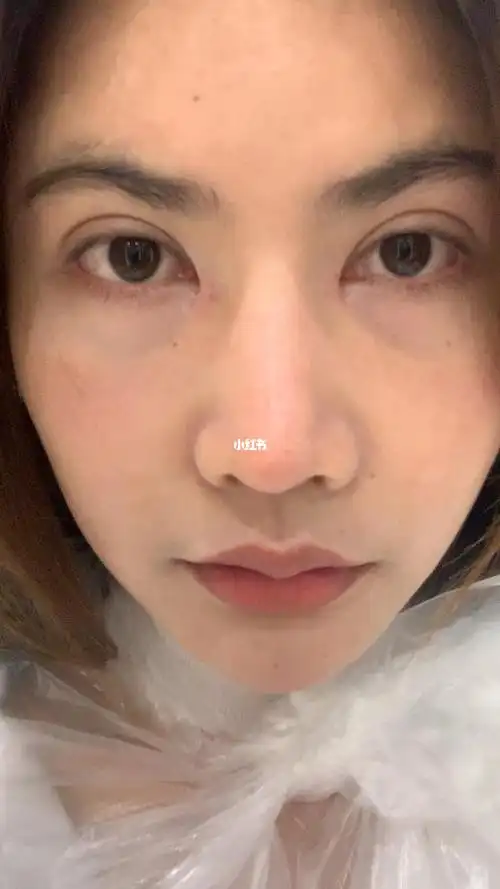 包眼角三个月啊这痕迹