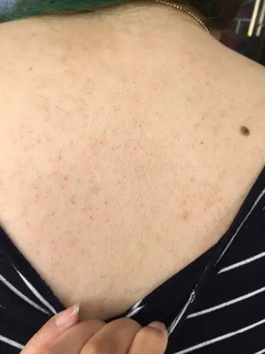 他们说我的后背都是黑色的毛,然后红红的,从高中开始,有图,帮我看