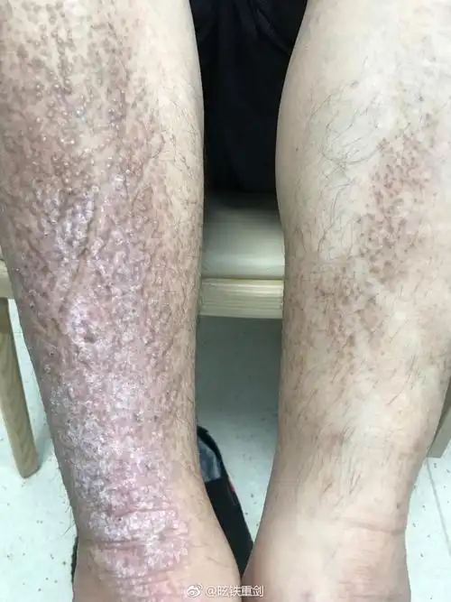 pasini-pierini皮肤萎缩(app):临床表现为位于躯干或四肢的色素沉着