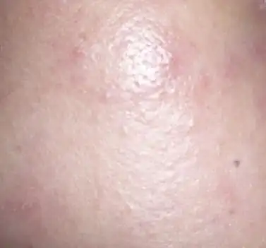 脸上皮肤过敏症状(图片) - 茚象泉皮肤过敏专家 - 脸上过敏怎么办