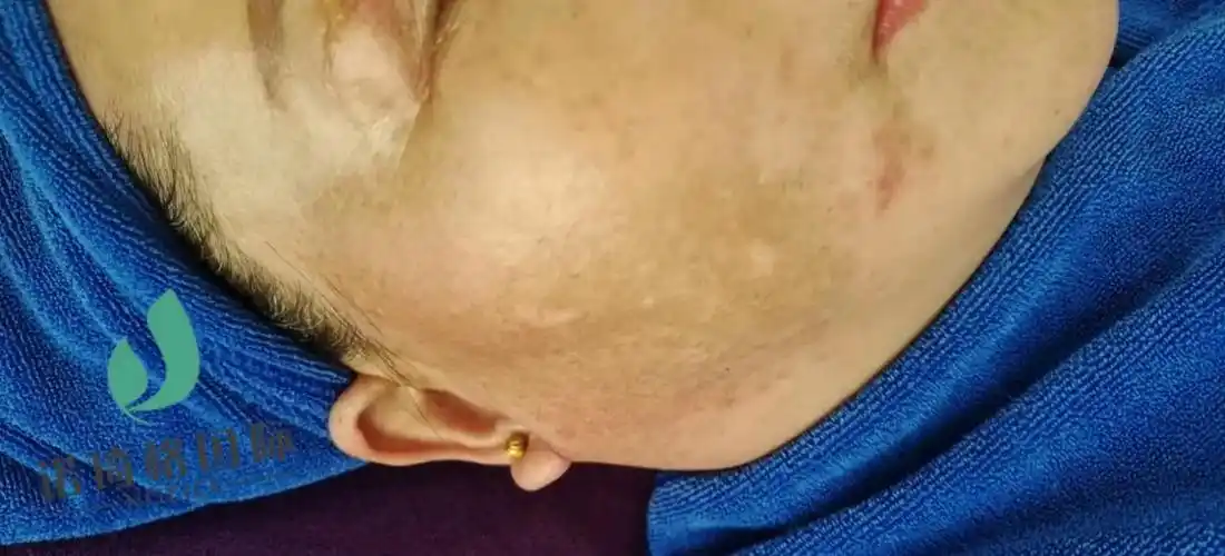 解决任何皮肤问题 ,斑花斑主任,大花脸地图,打造灯炮肌#真 - 抖音