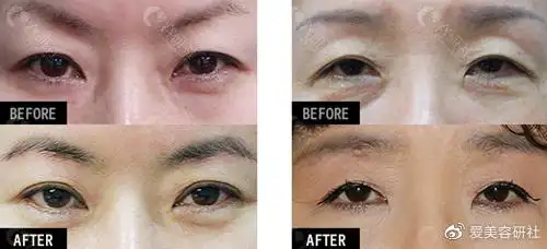 爱护医院提肌手术前后对比照