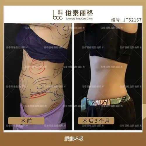 俊泰丽格#腰腹环吸