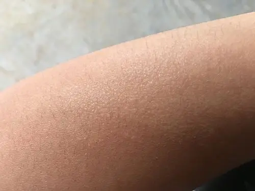 左手臂长癣,时不时会痒,越挠越痒