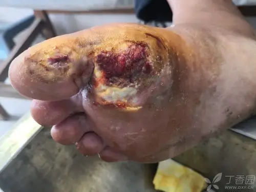 患者不愿意植皮有什么方式可以加快伤口愈合