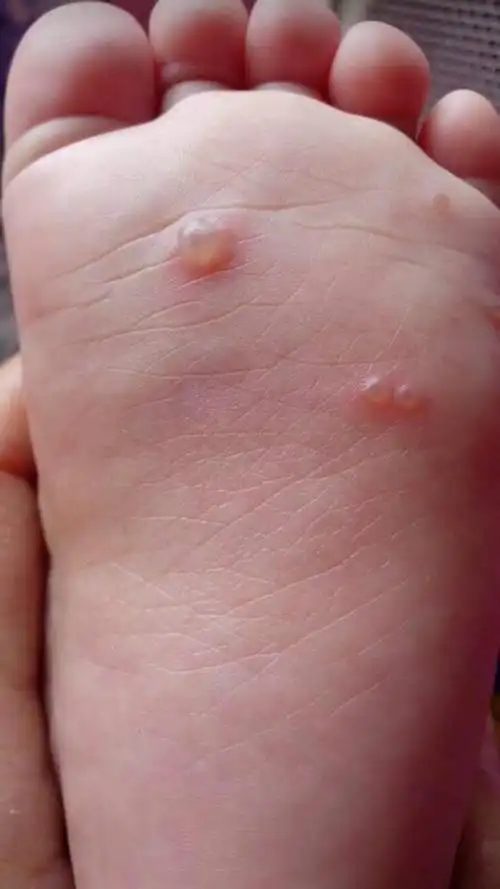 长水泡的预防方法