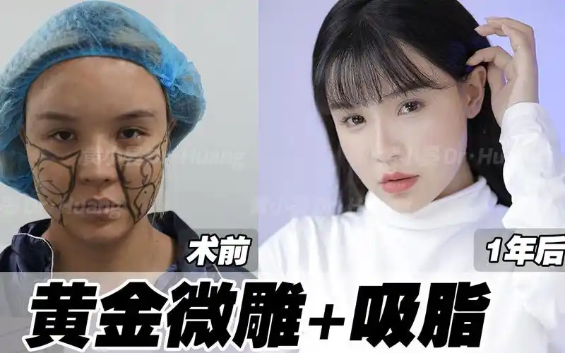 黄金微雕面吸小姐姐去年6月份做的面部黄金微雕吸脂今年反馈的效果