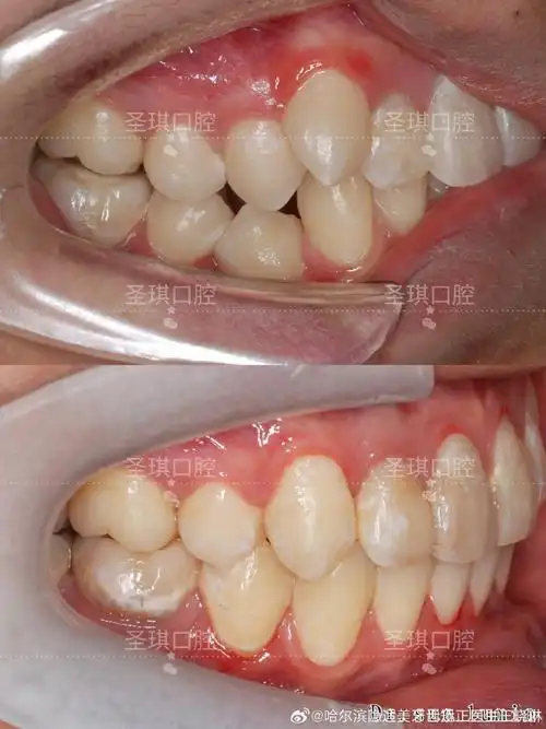 团队正畸案例##牙齿矫正##微笑线#今日案例～矫正前:两颗调皮的小虎牙