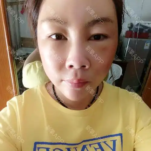 氧气v3afbec自体脂肪丰泪沟第3天美丽日记