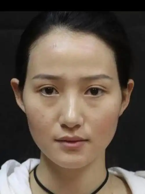 最烦恼的事情就是太阳穴太凹陷了,颧骨也比较明显,额头也是,整张脸松