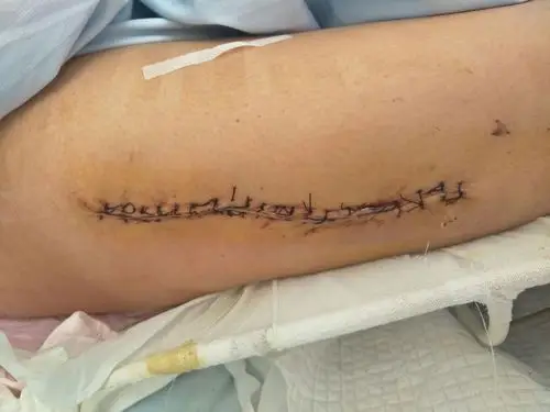 伤口清创缝合术后1周,伤口愈合良好