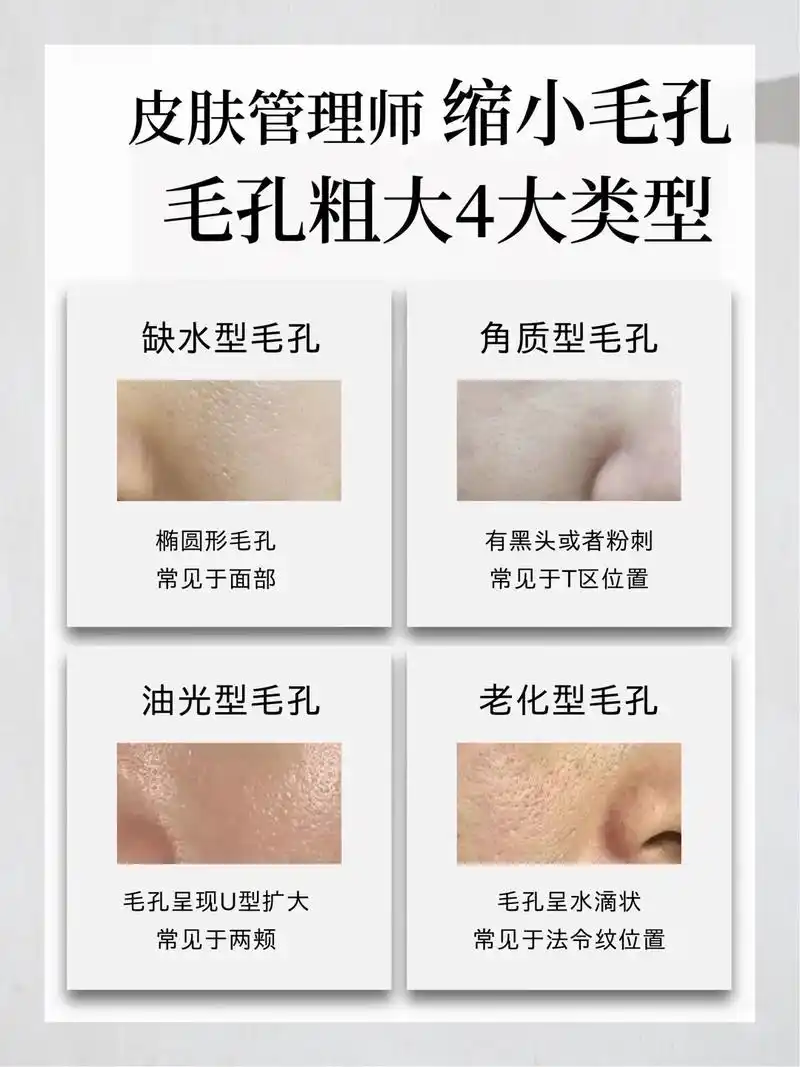 毛孔粗大的四个类型,问题表现和解决都整理好了!#皮肤管理 # - 抖音